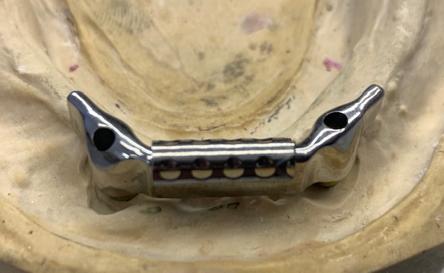 TELES DENTURE ON MILLED COPING