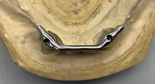 DENTURE ON LOCATOR IMPL