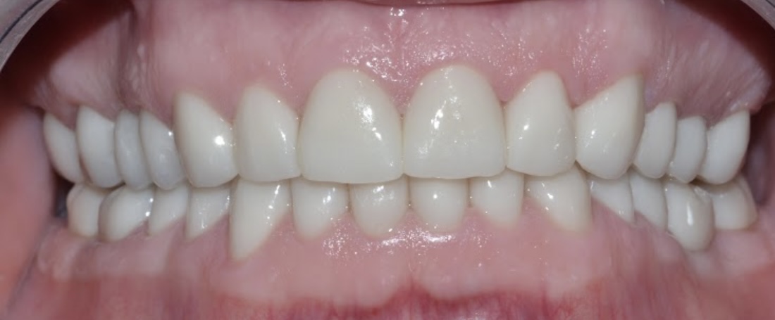gingival colors 3