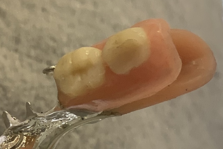 Softbase low 4 tooth CC denture